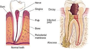 Tooth Decay